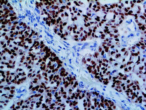 IHC of Estrogen Receptor BSB-1 on a FFPE Breast Carcinoma Tissue
